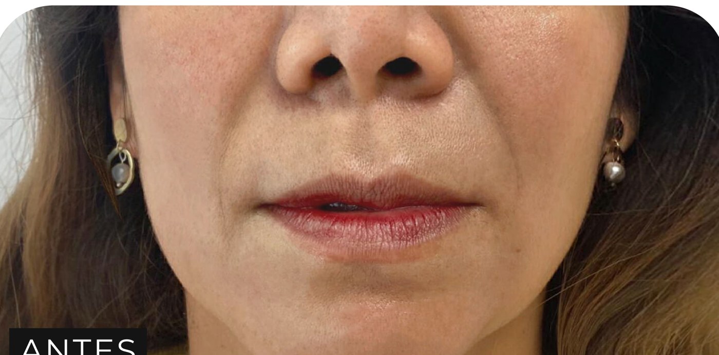 Antes de los fillers