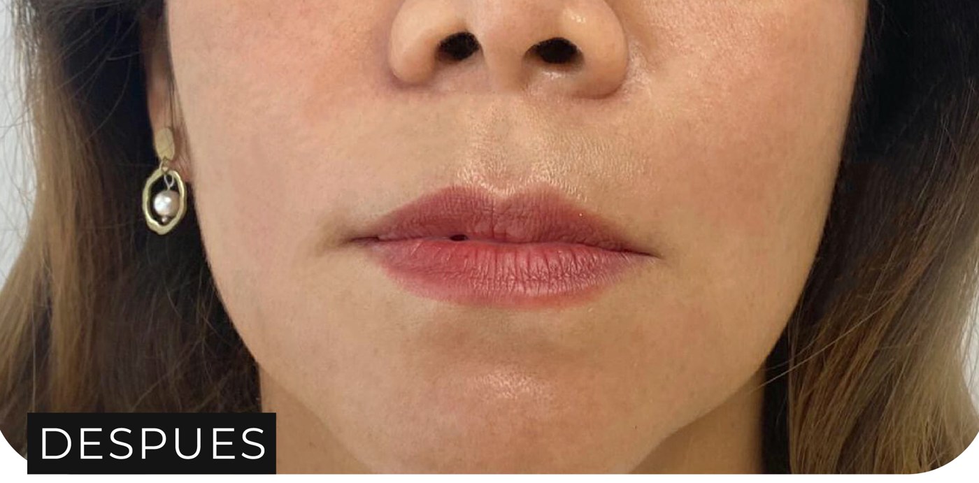 Después de los fillers