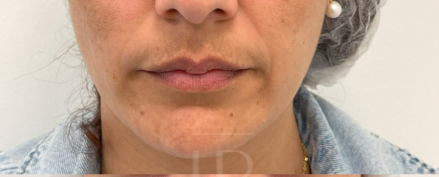 Antes de los fillers
