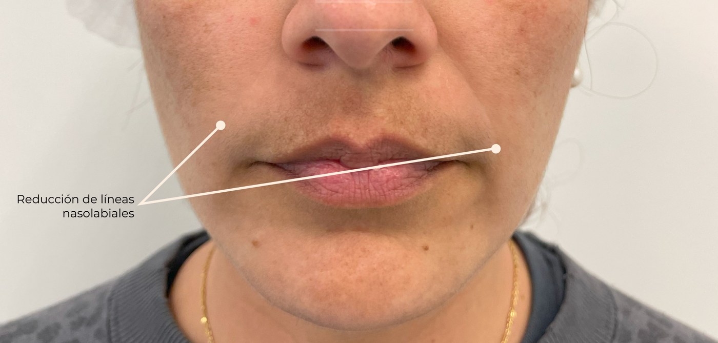 Después de los fillers