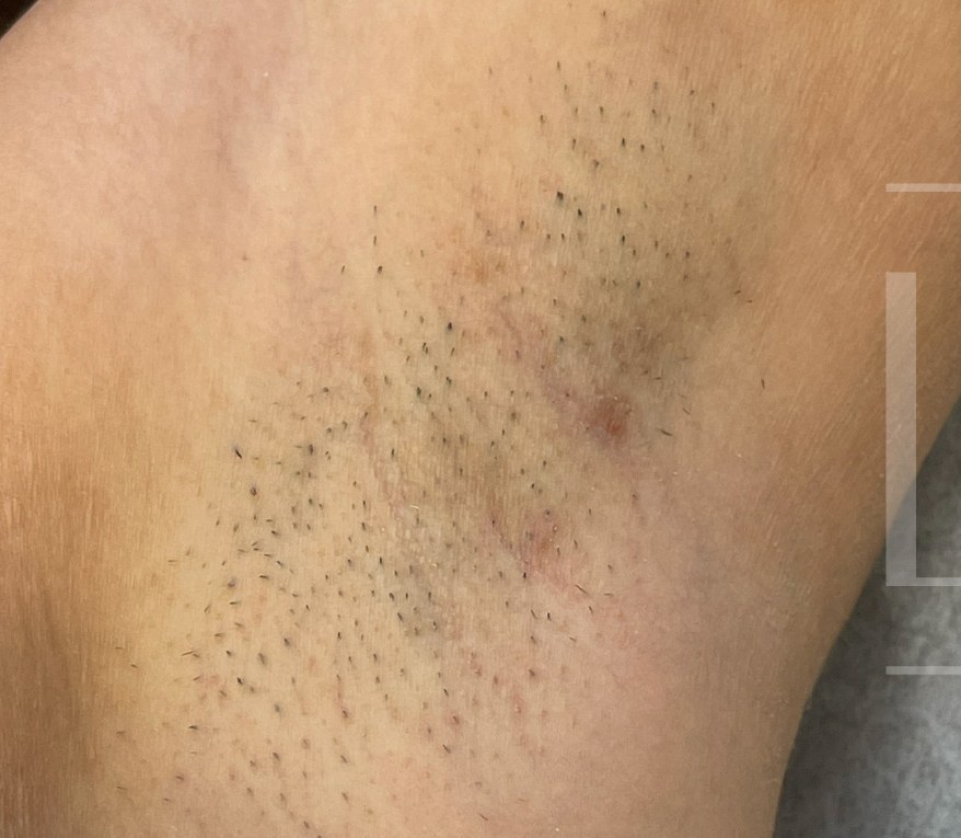 Before treatment