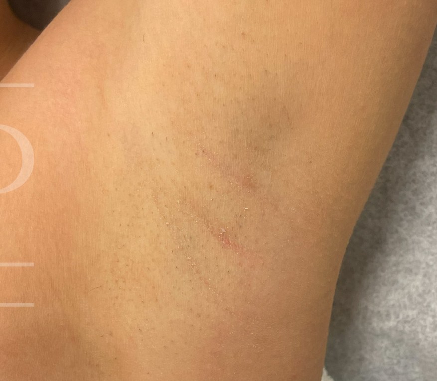 Underarm after treatment — real result