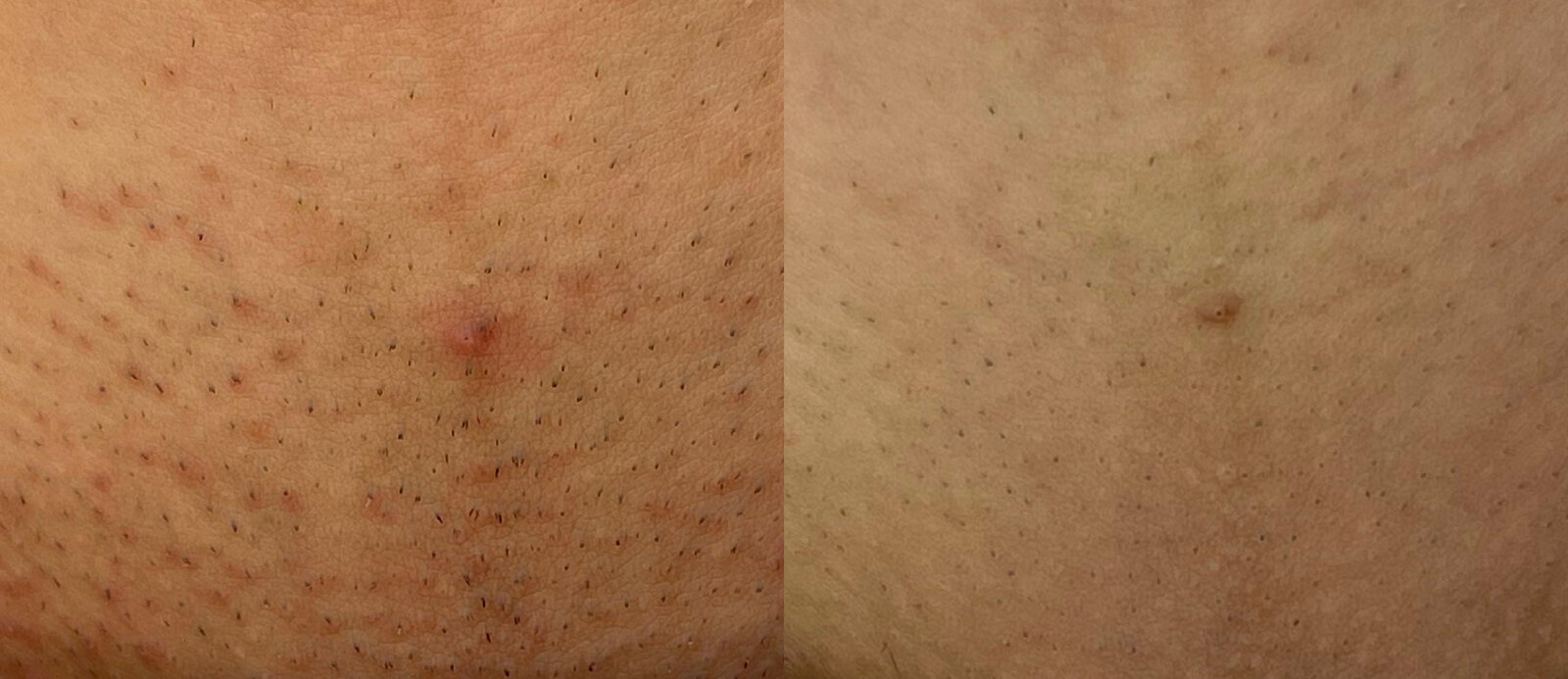 Antes y después — resultado real de Laser Place Miami