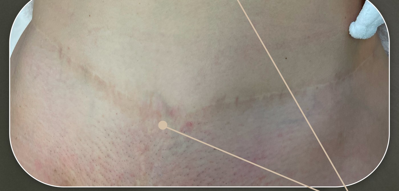 Después de Scarless Body